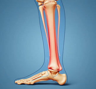 Наружный металлоостеосинтез