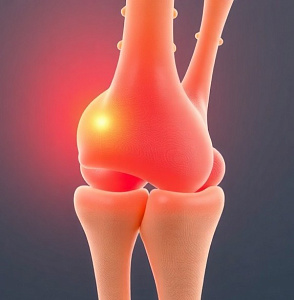 Реконструкция кости при ложном суставе