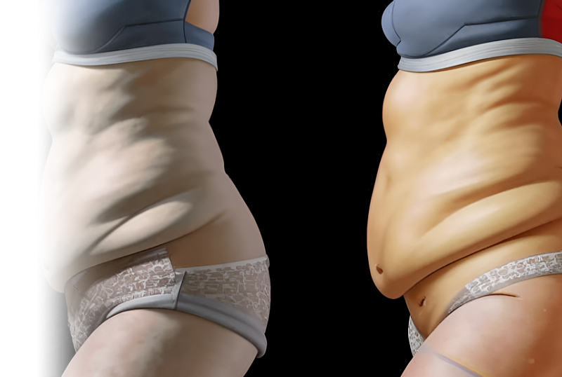 Липосакция