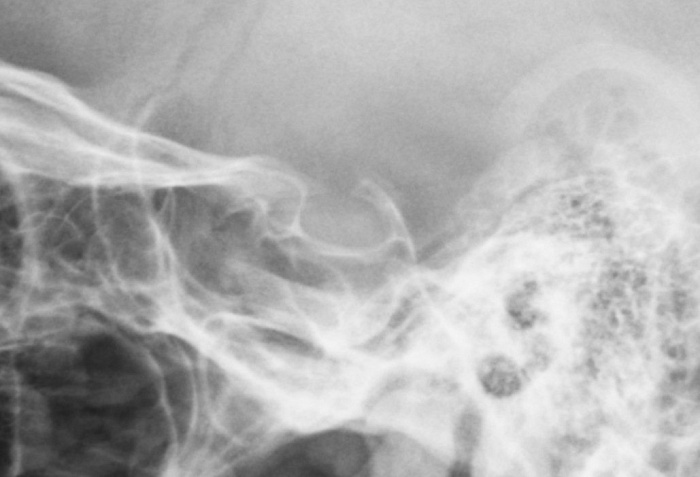 Рентгенография турецкого седла