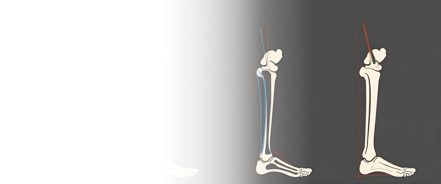 Наложение скелетного вытяжения