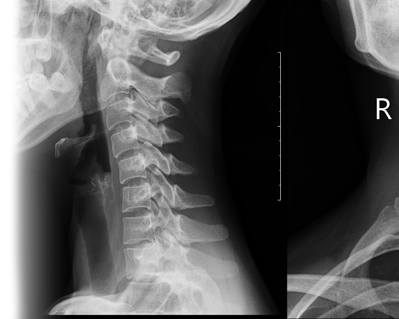 Рентгенография шейного отдела позвоночника
