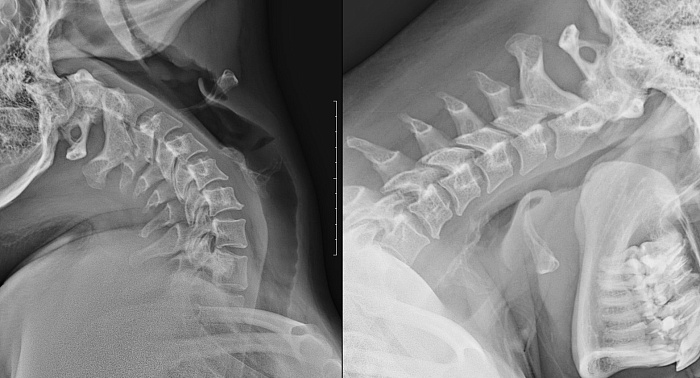 Рентгенография одного отдела позвоночника: функциональные пробы