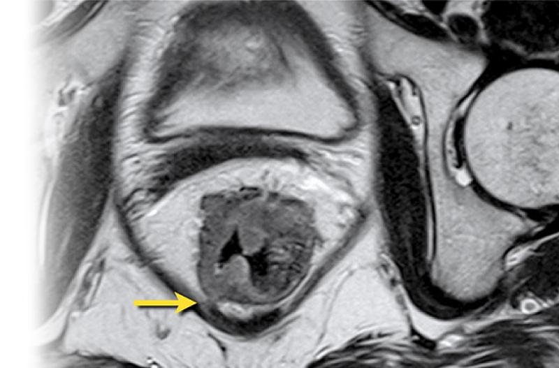 МРТ анального канала с контрастом