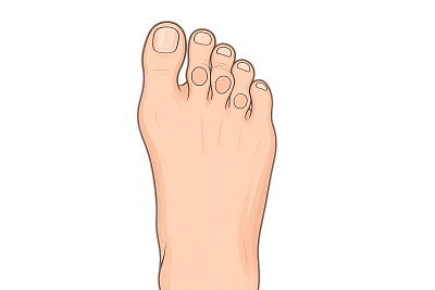 Молоткообразная деформация пальцев стопы