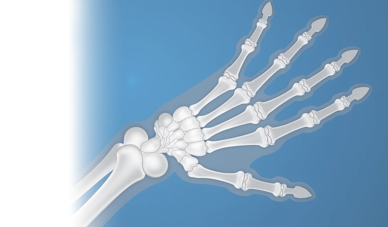 Операции при костных травмах кисти и их последствиях