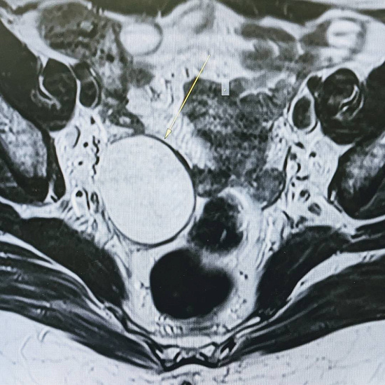 Цистаденома