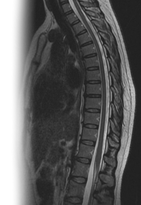 МРТ грудного отдела позвоночника
