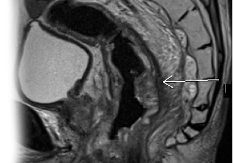 МР исследование прямой кишки и органов малого таза