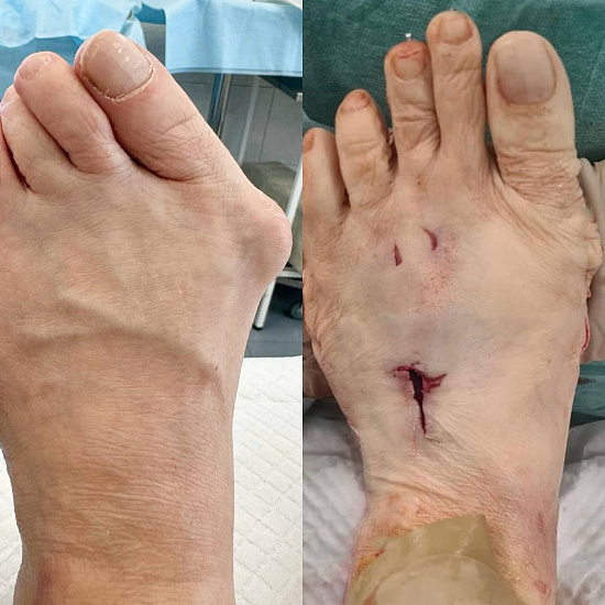 Продуваемые ветром пальцы ног