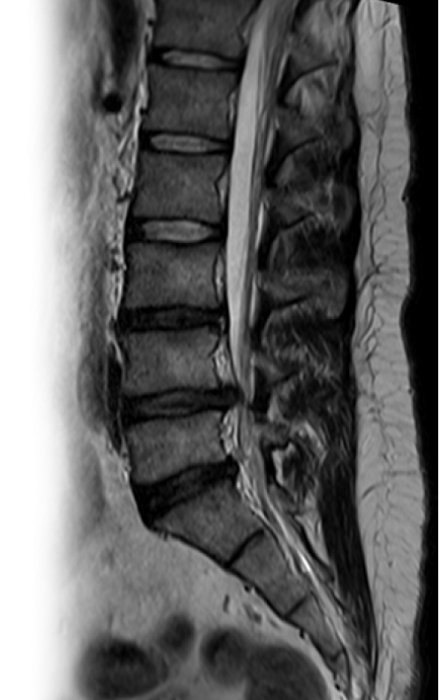 МРТ пояснично-крестцового отдела позвоночника
