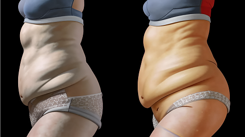 Липосакция