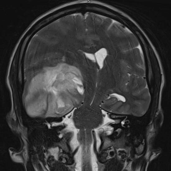 Нарушение зрения на правый глаз и частая головная боль