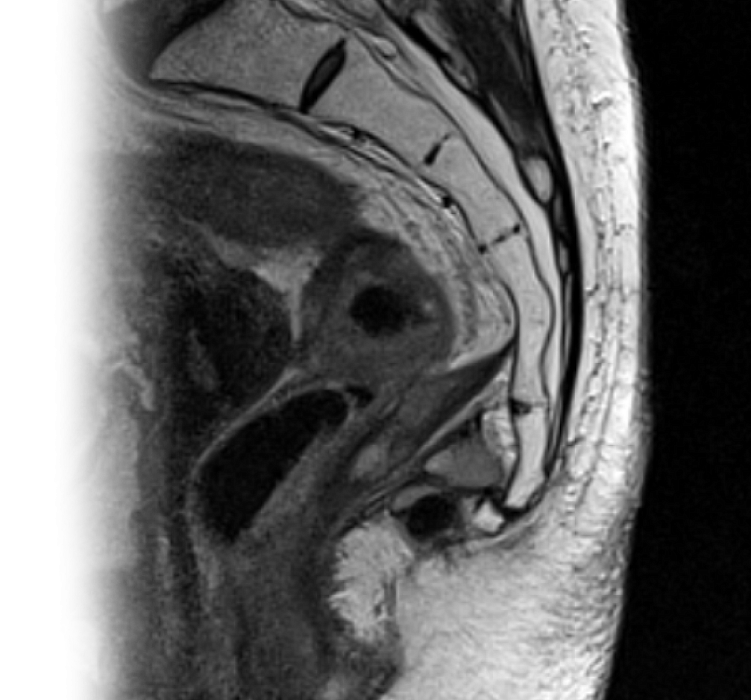 МРТ крестцово-копчикового отдела позвоночника