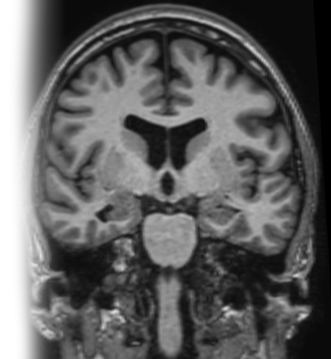 МРТ гиппокампов