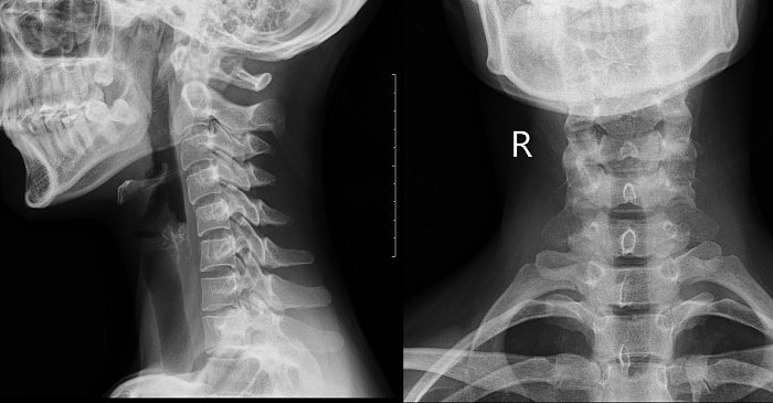Рентгенография шейного отдела позвоночника