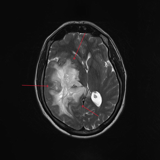Нарушение зрения на правый глаз и частая головная боль