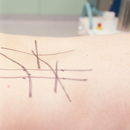 Рефлексотерапия